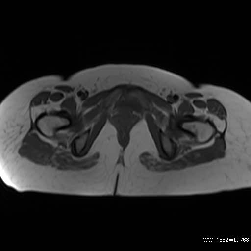 File:Bicornuate uterus- on MRI (Radiopaedia 49206-54297 Axial T1 15).jpg