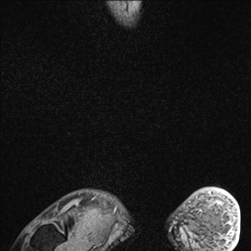 Bilateral Achilles tendon complete tear (Radiopaedia 81344-95051 Sagittal WE - Right 104).jpg