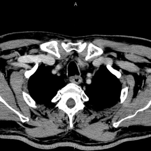Bilateral Warthin tumors (Radiopaedia 84034-99263 Axial With contrast 65).jpg