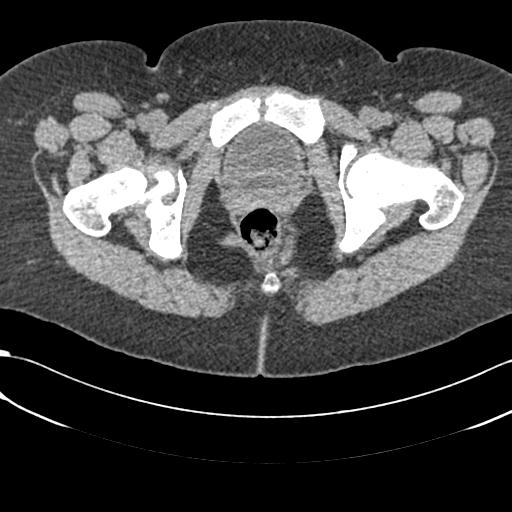 File:Bilateral acetabular protrusion with pincer type femoro-acetabular impingement (Radiopaedia 30134-30733 AXIAL SOFT THIN 64).jpg