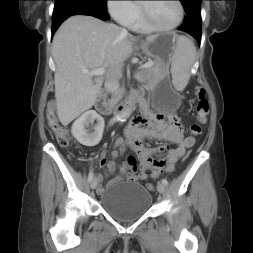 Bilateral adrenal granulocytic sarcomas (chloromas) (Radiopaedia 78375-91007 B 42).jpg
