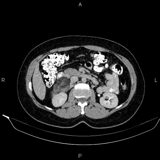 File:Bilateral adrenal myelolipoma (Radiopaedia 63058-71535 Axial C+ delayed 51).jpg