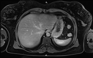 File:Bilateral adrenal myelolipoma (Radiopaedia 63058-71537 H 18).jpg