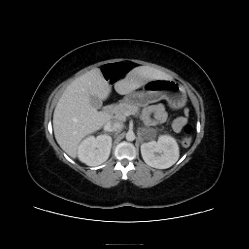 Bilateral adrenal thrombosis (Radiopaedia 58182-65256 A 23).jpg