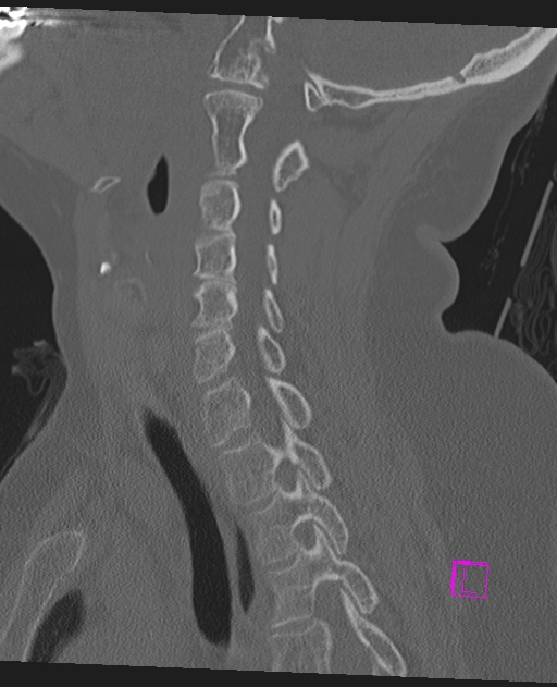 Bilateral atlanto-occipital assimilation (Radiopaedia 28350-28603 Sagittal bone window 47).jpg