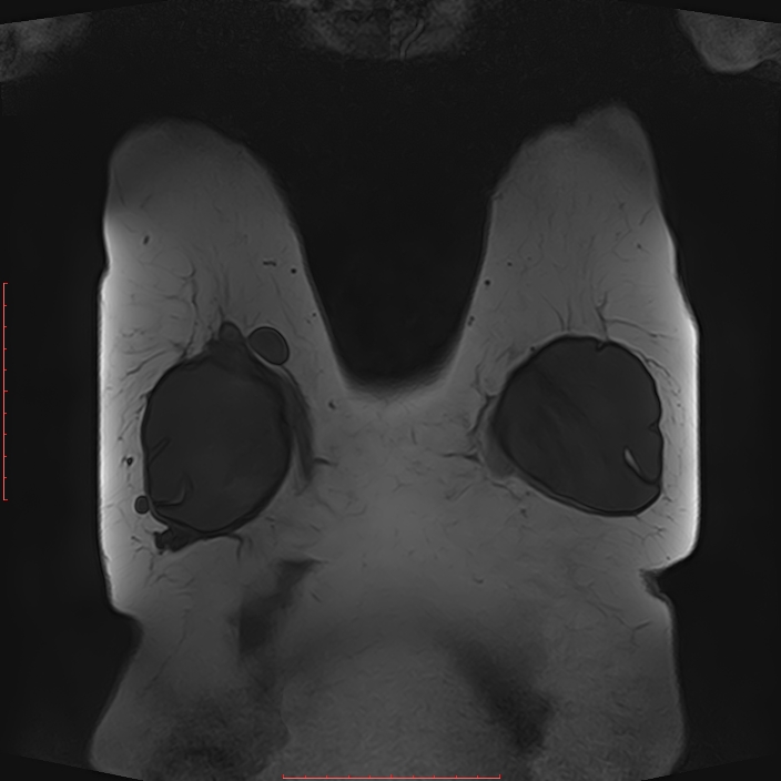 Bilateral breast implant rupture (Radiopaedia 24761-25027 G 57).jpg