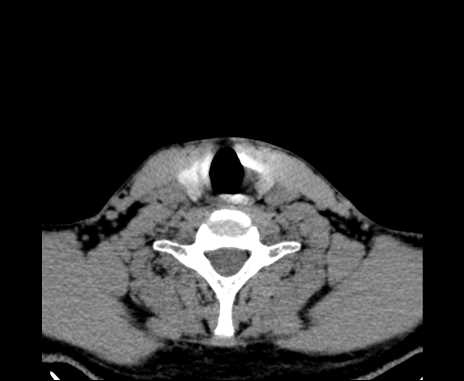 Bilateral carotid body tumors (Radiopaedia 61841-69870 Axial non-contrast 85).jpg