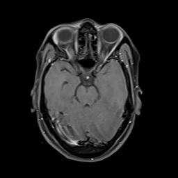 File:Bilateral carotid body tumors and right jugular paraganglioma (Radiopaedia 20024-20060 Axial 113).jpg