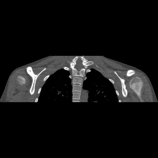 Bilateral chronic posterior shoulder dislocation (Radiopaedia 39213-41452 Coronal bone window 38).jpg