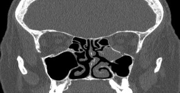 File:Bilateral ectopic infraorbital nerves (Radiopaedia 49006-54084 Coronal 27).png