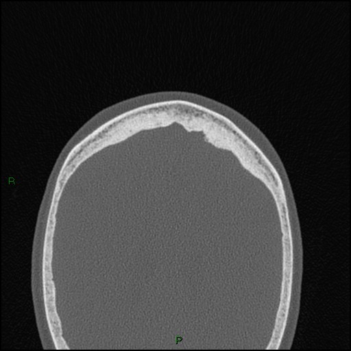 Bilateral frontal mucoceles (Radiopaedia 82352-96454 Axial bone window 22).jpg