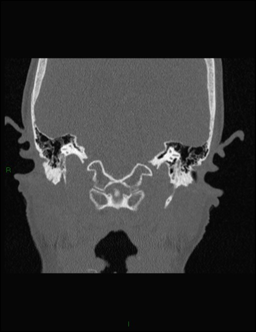 Bilateral frontal mucoceles (Radiopaedia 82352-96454 Coronal 319).jpg