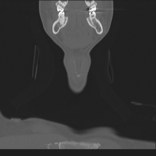 Bilateral locked facets (Radiopaedia 33850-35016 Coronal bone window 7).png