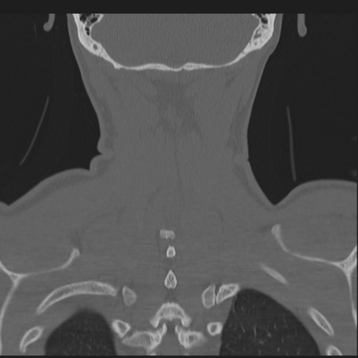 Bilateral locked facets (Radiopaedia 33850-35016 Coronal bone window 74).png