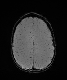 Bilateral mesial temporal polymicrogyria (Radiopaedia 76456-88181 Axial SWI 53).jpg