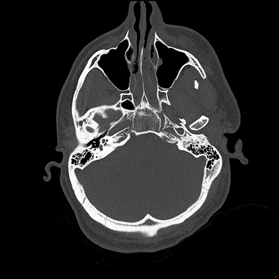 File:Bilateral occipital condyle fracture (type 2) (Radiopaedia 87675-104089 Axial bone thins 56).jpg