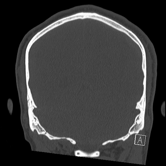 Bilateral occipital condyle fracture (type 2) (Radiopaedia 87675-104089 Coronal bone window 104).jpg