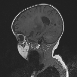 File:Bilateral optic pathway gliomas (Radiopaedia 40013-42514 Sagittal T1 6).jpg
