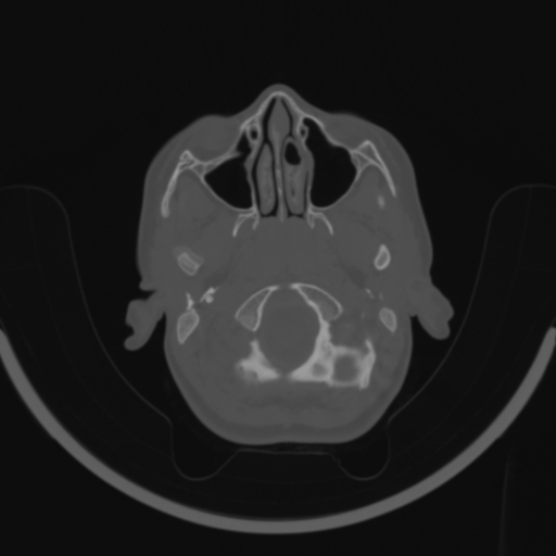 Bilateral otosclerosis (Radiopaedia 57237-64157 C 9).jpg