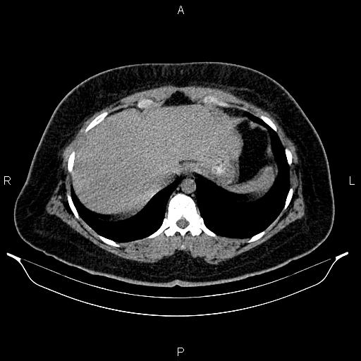 File:Bilateral ovarian dermoid cysts (Radiopaedia 85785-101603 Axial C+ delayed 4).jpg