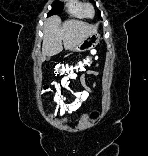 File:Bilateral ovarian dermoid cysts (Radiopaedia 85785-101603 C 5).jpg