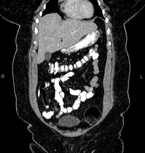 Bilateral ovarian dermoid cysts (Radiopaedia 85785-101603 C 8).jpg