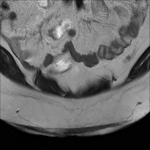 File:Bilateral ovarian dermoid cysts (Radiopaedia 90152-107338 Coronal T2 3).jpg