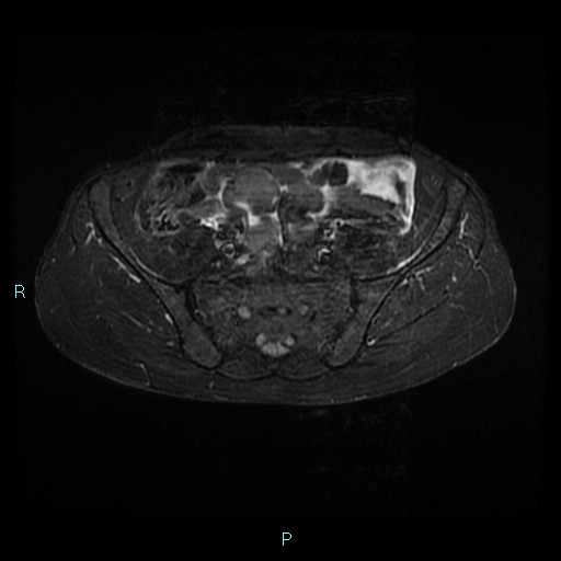 File:Bilateral ovarian fibroma (Radiopaedia 44568-48293 Axial STIR 6).jpg