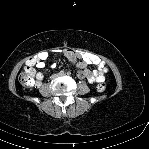 Bilateral ovarian serous cystadenocarcinoma (Radiopaedia 86062-101989 Axial C+ delayed 45).jpg