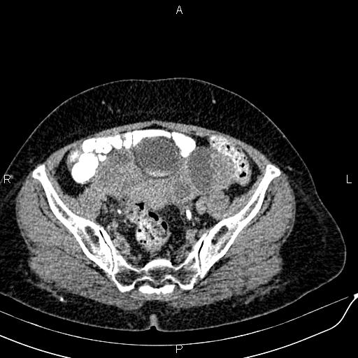 Bilateral ovarian serous cystadenocarcinoma (Radiopaedia 86062-101989 Axial C+ delayed 63).jpg