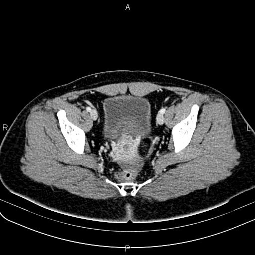 Bilateral ovarian teratoma (Radiopaedia 83131-97503 Axial With contrast 51).jpg