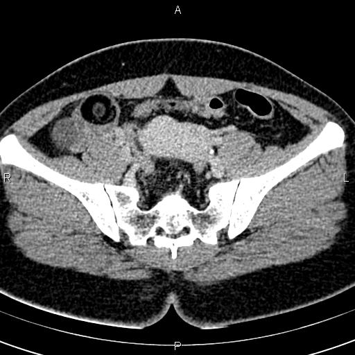 Bilateral ovarian teratoma (Radiopaedia 83131-97503 B 28).jpg
