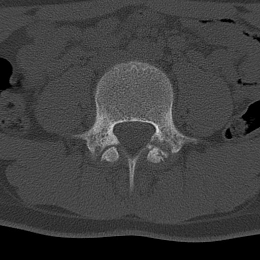 Bilateral pars defect (Radiopaedia 26691-26846 Axial bone window 25).jpg