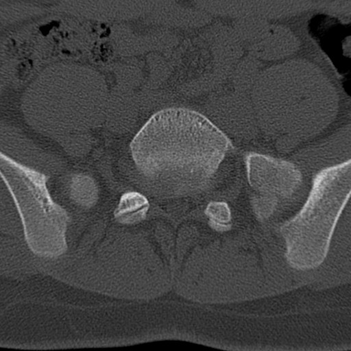 Bilateral pars defect (Radiopaedia 26691-26846 Axial bone window 67).jpg