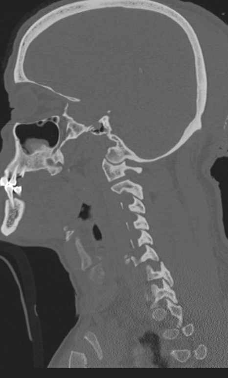 Bilateral perched facet joint (Radiopaedia 63149-71669 Sagittal bone window 51).jpg