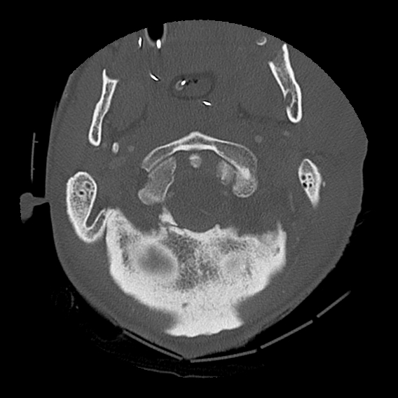 Bilateral perched facets with cord injury (Radiopaedia 45587-49713 Axial bone window 23).jpg