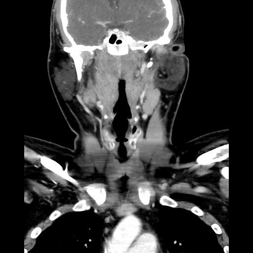 File:Bilateral peritonsillar abscess (Radiopaedia 85065-100610 Coronal 38).jpg