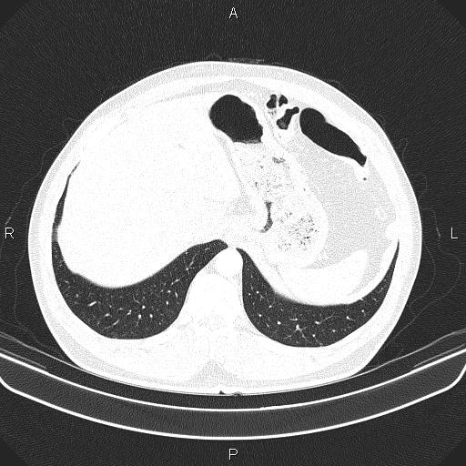 File:Bilateral pulmonary AVM (Radiopaedia 83134-97505 Axial lung window 67).jpg