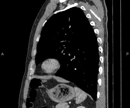Bilateral pulmonary AVM (Radiopaedia 83134-97505 D 82).jpg