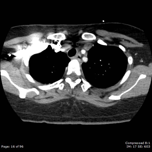 File:Bilateral pulmonary emboli with Hampton hump sign (Radiopaedia 54070-60246 Axial C+ CTPA 13).jpg