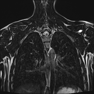 Bilateral spinoglenoid notch ganglion cysts (Radiopaedia 29577-30082 Coronal T2 89).jpg