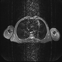 File:Bilateral spinoglenoid notch ganglion cysts (Radiopaedia 29577-30082 E 22).jpg