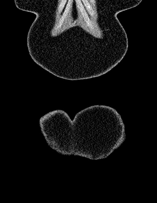 Bilateral staghorn calculi (Radiopaedia 59475-66842 Coronal non-contrast 26).jpg