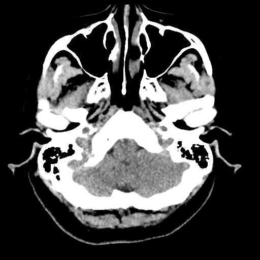 File:Bilateral subacute subdural hematoma (Radiopaedia 69240-79018 Axial non-contrast 7).jpg