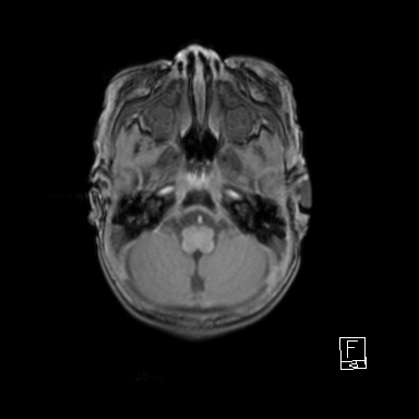 File:Bilateral subdural hemorrhage and parietal skull fracture (Radiopaedia 26058-26190 Axial T1 9).png