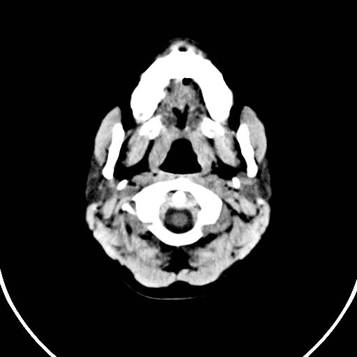 File:Bilateral subgaleal hematomata (Radiopaedia 13457).jpg