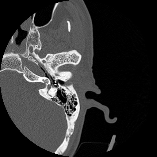 Bilateral temporal bone fractures (Radiopaedia 29482-29970 D 76).jpg