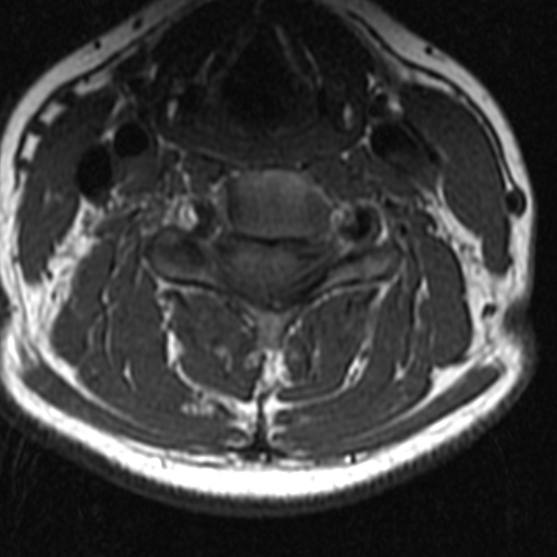 File:Bilateral tortuous vertebral arteries (Radiopaedia 19070-19039 Axial T2 10).jpg