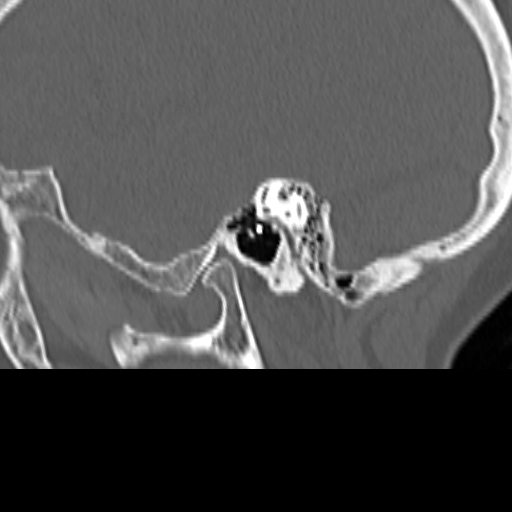 File:Bilateral tympanoplasty (Radiopaedia 16947-16664 Sagittal bone window 22).jpg