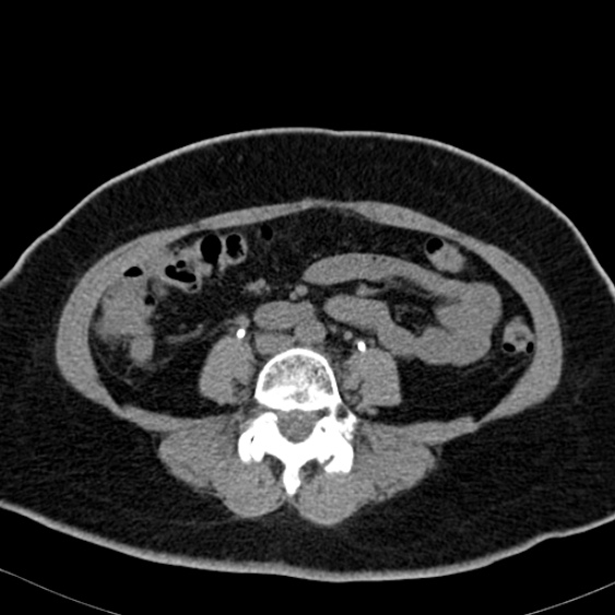 Bilateral ureteric stents (Radiopaedia 48795-53825 Axial non-contrast 35).jpg